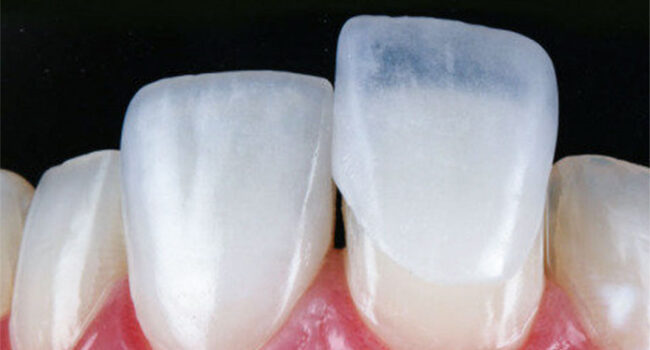 lente-de-contato-dental-novo