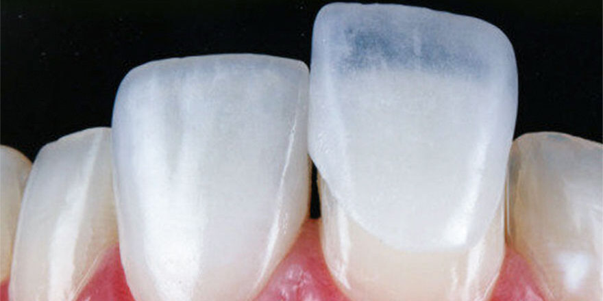 lente-de-contato-dental-novo
